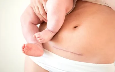 How Long Do Stitches After Delivery Take to Heal and How Should You Care for Them?