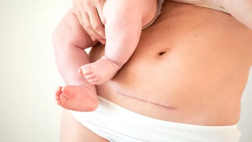 Stitches After Delivery Healing Time and Care