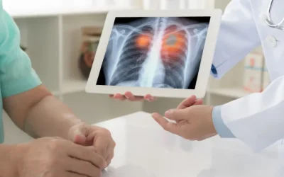 Lung Nodules on CT Scans: What They Mean and When to Worry