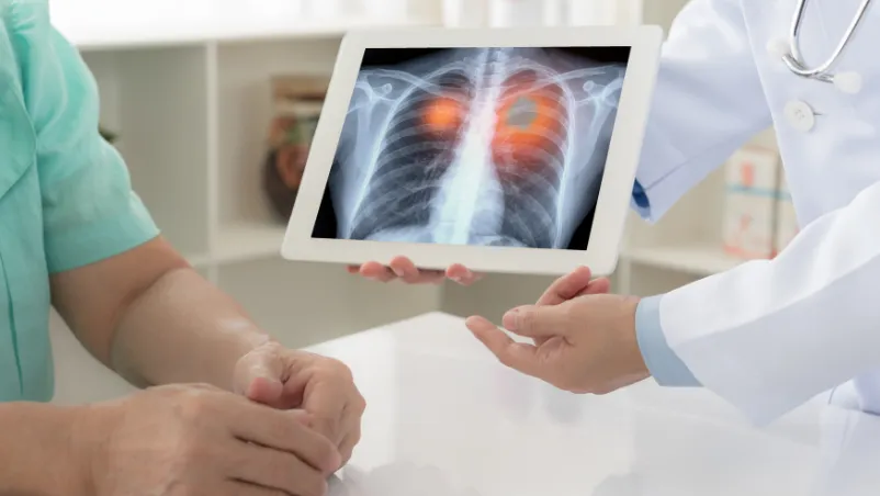 Lung Nodule on CT Scan