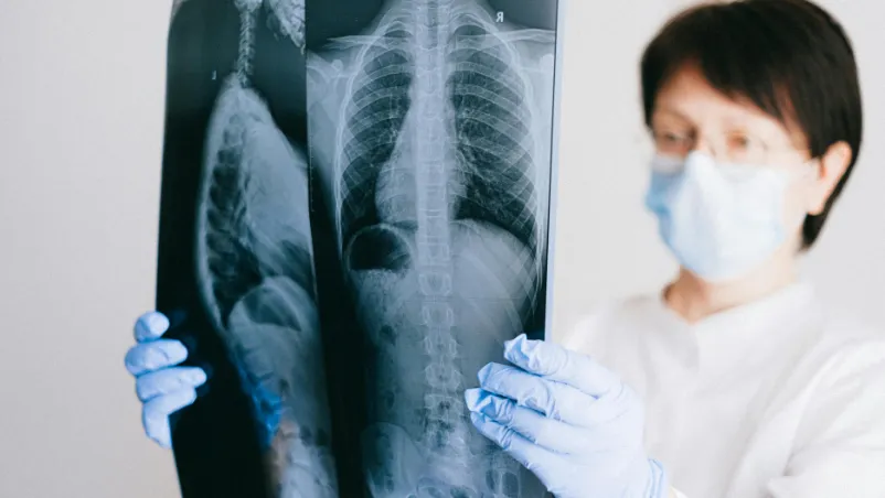 Can Long COVID Actually Damage Your Lungs Permanently