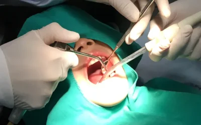 Dental Surgery Cost Without Insurance: What to Expect